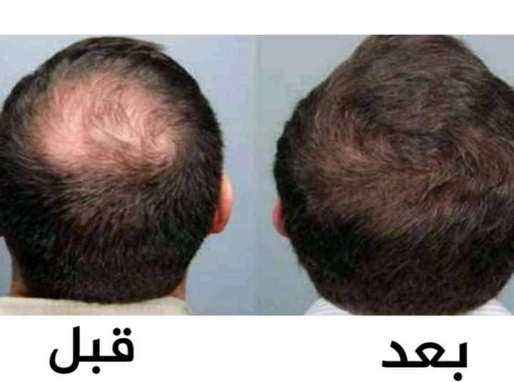 تساقط الشعر