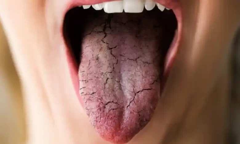 جفاف الفم ينذر بخمسة أمراض خطيرة.. تعرف عليها