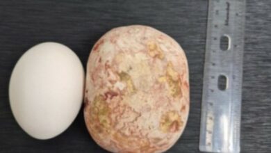 صدمة طبية.. أطباء يستخرجون حصوة وزنها 1 كغ من مثانة رجل! 5