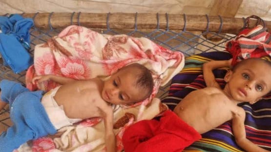 تقرير أممي: تفاقم سوء التغذية بين الأطفال في اليمن 1