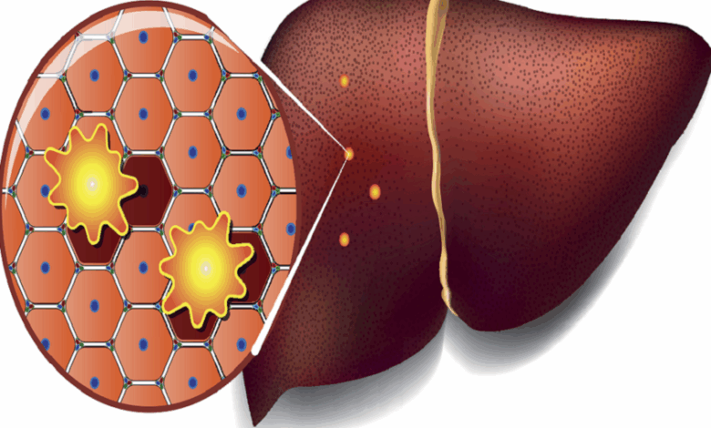 تحذير صحي جديد: الأطعمة الدهنية قد تفتح أبواب السرطان للكبد 11