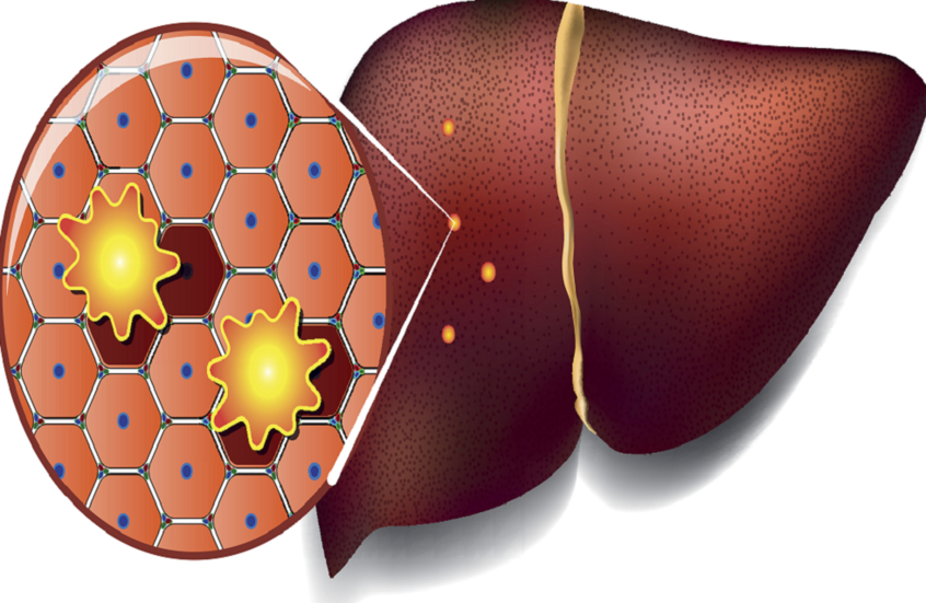 تحذير صحي جديد: الأطعمة الدهنية قد تفتح أبواب السرطان للكبد 1