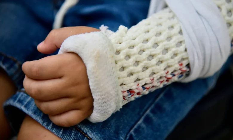 الجبس ينافس الجراحة: دراسة تكشف مفاجأة في علاج كسور الأطفال! 4